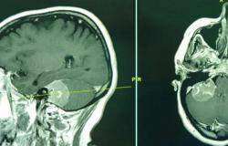عملية معقّدة تنهي معاناة أربعينية من ورم في الدماغ بمستشفى سليمان الحبيب بالقصيم