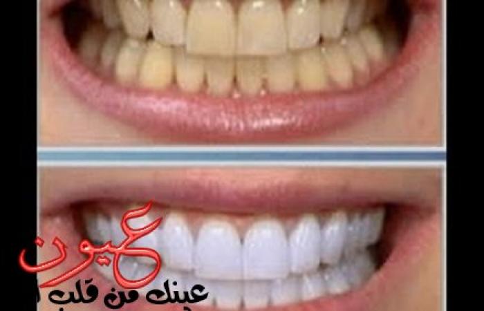 الوصفة المعجزة لتبييض الأسنان المصفرة من أول استعمال