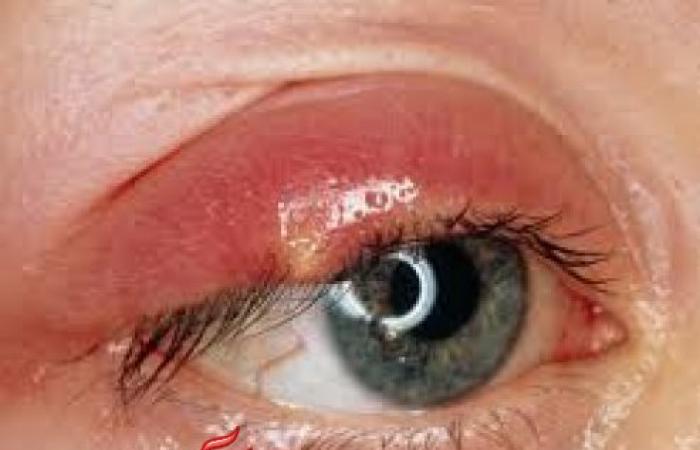 تعرف على أسباب دمل العين ، وطرق العلاج الطبيعية