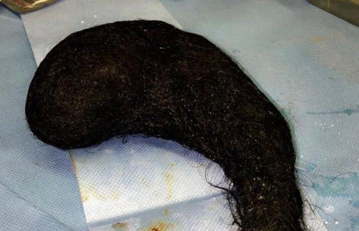 اكتشاف كتلة من الشعر داخل معدة امرأة سعودية.. والسبب