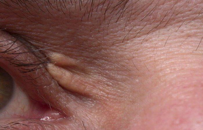 هذه النتوءات الصفراء على الجلد قد تكون علامة تحذيرية لحالة خطيرة