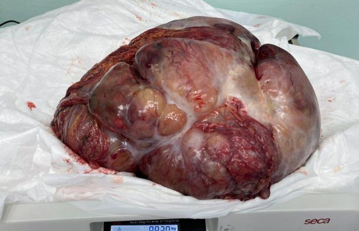 فريق طبي سعودي يستأصل ورمًا وزنه 8 كجم من بطن أربعيني بمستشفى سليمان الحبيب