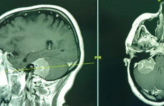 عملية معقّدة تنهي معاناة أربعينية من ورم في الدماغ بمستشفى سليمان الحبيب بالقصيم