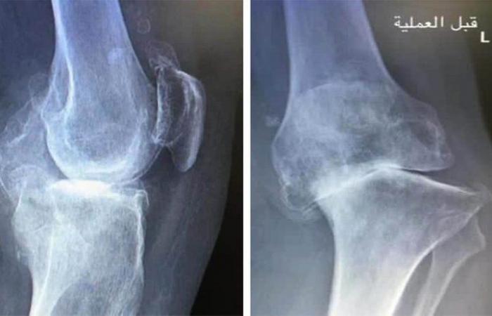 استبدال مفصل الركبة بمستشفى سليمان الحبيب يعيد الحركة لـ"سبعيني" مُقعد