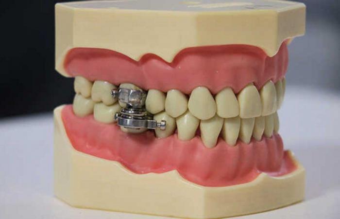 "قفل على الأسنان".. علماء يطورون جهازًا يمنع الأكل للقضاء على السمنة