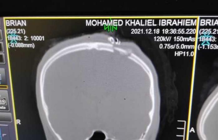 إجراء جراحة ذات مهارة لمريض يعاني من كسر بالجمجمة