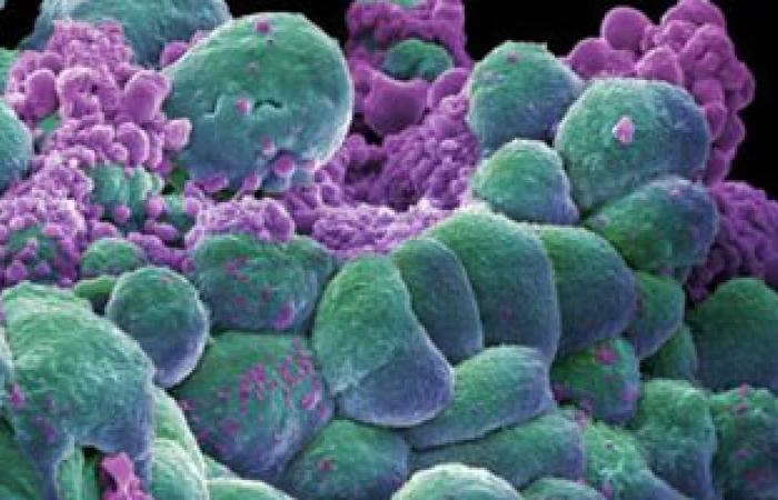 خلايا سرطان الثدى تطلق بروتينات واقية يمكنها التصدى للأورام