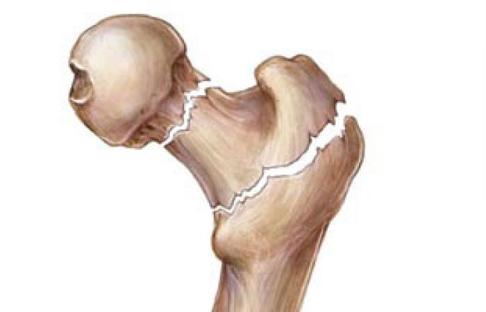 7 أعراض لالتهاب العظام تؤثر على باقى أعضاء الجسم