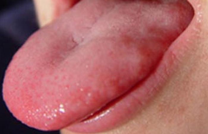 أول مصل لوقاية الأطفال من أمراض الفم واليد والقدم
