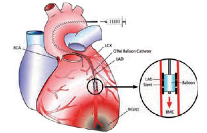 جهاز تنظيم ضربات القلب يساعد على علاج ارتفاع ضغط الدم