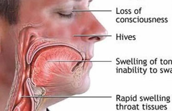 انحراف الحاجز الأنفى يسبب الالتهابات وحدوث مشاكل فى التنفس