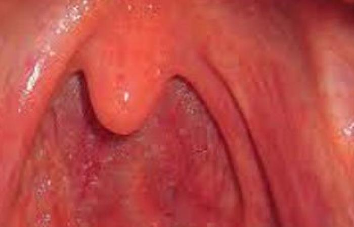 طبيب أنف وأذن يوضح أسباب التهابات الحلق