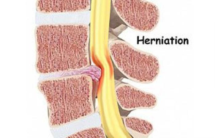 تعرف على أسباب الإصابة بالانزلاق الغضروفى بالرقبة