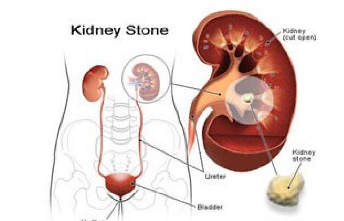ارتفاع الحرارة يسبب حصوات الكلى فاحرص على شرب الماء وتناول البطيخ