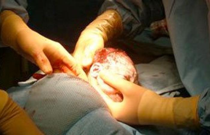 استشارى نساء وتوليد: تزايد نسب حالات الولادة القيصرية فى مصر إلى 52%