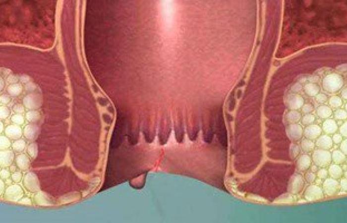 خايف من البواسير.. اعرف أعراضها وأسبابها