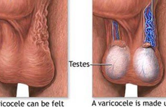 انخفاض الخصوبة لدى الرجال يرفع خطر الإصابة بسرطان الخصية 3 أضعاف