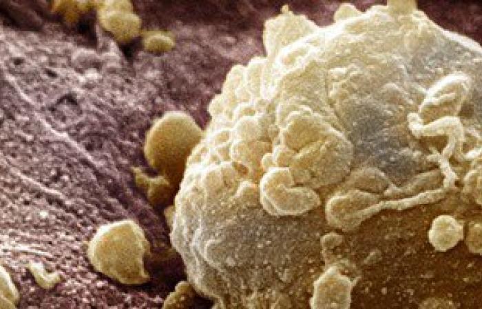 علاج جديد للسرطان لا يضر خلايا الجسم ويتفوق على الكيماوى