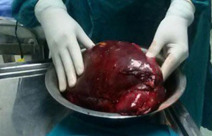 بالصور..استئصال ورم سرطانى يزن 14 كجم لمريض بمستشفى جامعة المنوفية