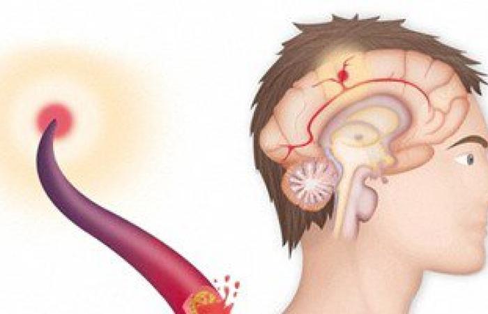 دراسة: خطر الإصابة بالسكتة الدماغية يتضاعف خلال ساعة من شرب الكحول