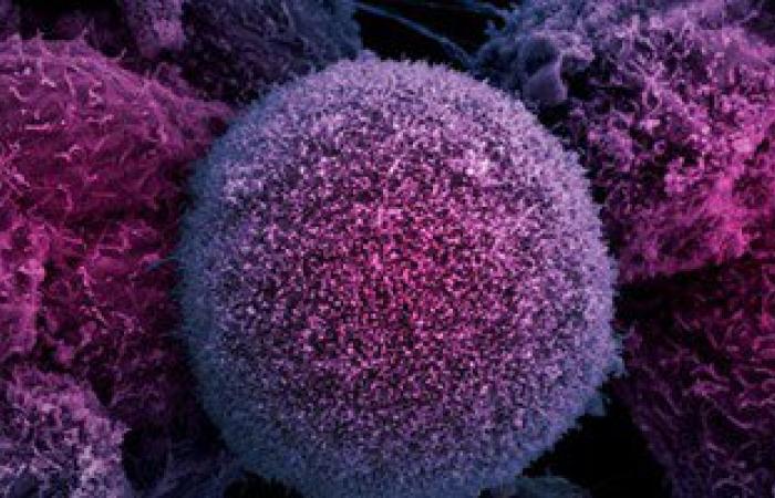 أستاذ أشعة تداخلية: استخدام الجسيمات المشعة يقضى على سرطان الكبد