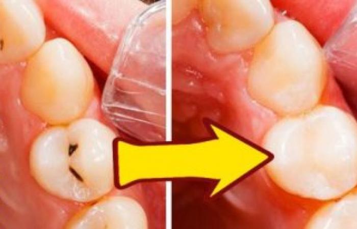 طريقة التخلص من تسوس الاسنان فى يوم واحد