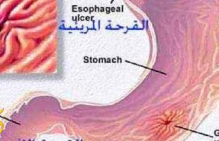 وصفة طبيعيه للتخلص من قرحة المعدة نهائيا