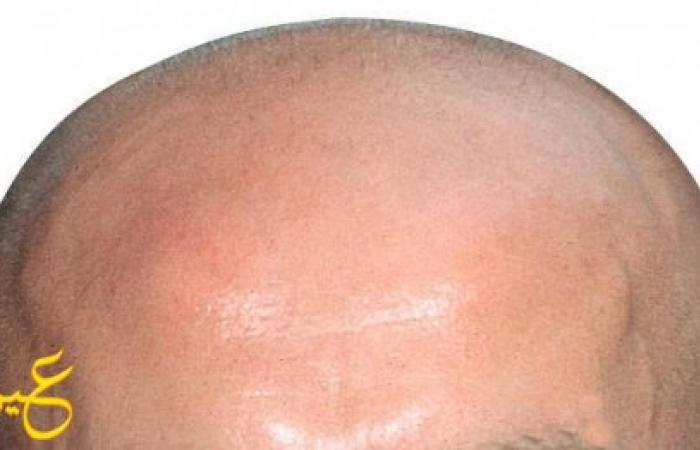 نصائح قبل وبعد عملية زراعة الشعر