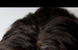 ما الفرق بين الصدفية وقشرة الشعر؟ تعرف على الإجابة