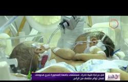 الأخبار - في جراحة طبية نادرة...مستشفى جامعة المنصورة تجري فحوصات لفصل توأم ملتصق