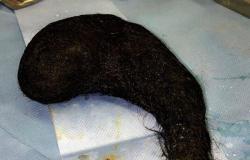 اكتشاف كتلة من الشعر داخل معدة امرأة سعودية.. والسبب