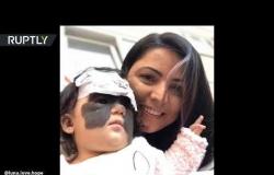 شاهد طفلة "لونا" الأمريكية بعد أولى عملية حراحية في روسيا لإزالة وحمة من وجهها