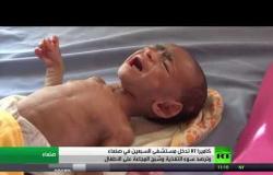 سوء التغذية والمجاعة يفتكان بأطفال اليمن