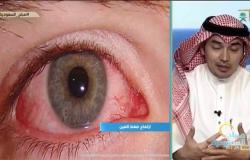 استشاري طب عيون يحذِّر: "السويرق" يخطف البصر دون أعراض