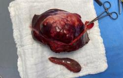 عملية ناجحة لاستئصال أحد فصي الكبد بالمنظار الجراحي في مستشفى عسير