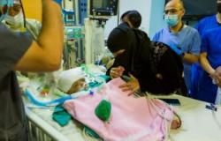 الفريق الجراحي لفصل التوأم اليمني الملتصق بالرأس يعلنُ وفاة أحدهما