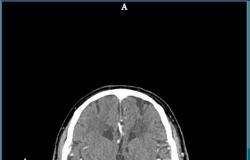 إنقاذ أول حالة جلطة دماغية من خلال ⁧‫الطب الاتصالي‬⁩ بمستشفى المجمعة‬⁩