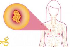 اعراض مبكرة تكشف عن سرطان الثدي
