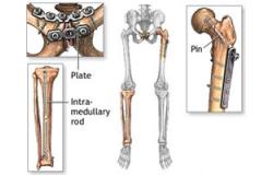 "جراحة العظام المصرية" تناقش أحدث تقنيات تطويل الأقدام