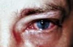 حساسية العين.. الأعراض والأسباب والعلاج