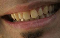 الجز على الأسنان يؤدى إلى تلفها وتآكلها