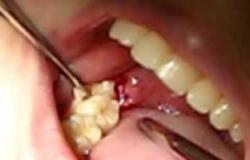 الإهمال فى التهابات الأسنان يجعلها مزمنة ويسبب آلاما فى العصب