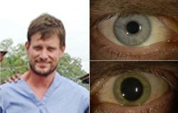 طبيب بريطانى يكتشف إصابته بالإيبولا فى عينيه بعد تحولها من الأزرق للأخضر