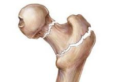 هشاشة العظام تزيد من مخاطر الإصابة بالصمم المفاجئ