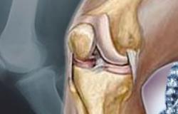 جراحة استبدال الركبة تحد من آلام المفاصل
