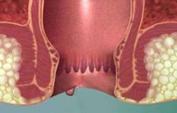 تعرف على الفرق بين الناسور الشرجى والبواسير