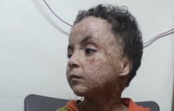بعد نشر"اليوم السابع"مأساة طفل حوله حريق منزله إلى "شبح".. الاستجابات تتوالى