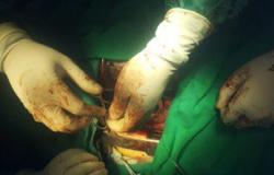 جراحة لتغيير صمام "ميترالى" تنقذ مريضة من الموت بمستشفى جامعة بنى سويف