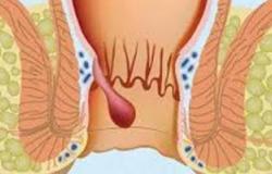أسباب وأعراض البواسير..أهمها الإمساك المزمن وقطرات دم فى البراز