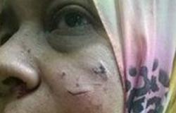 تداول صورة لتشويه بلطجية وجه طبيبة بمستشفى القاهرة الفاطمية